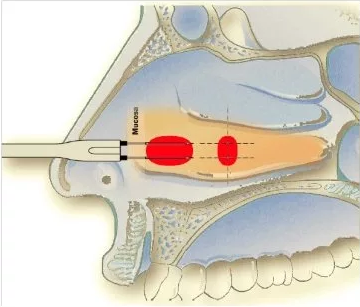 Подслизистой вазотомии нижних раковин